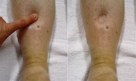 shin compression pitting edema test|blood test for pitting edema.